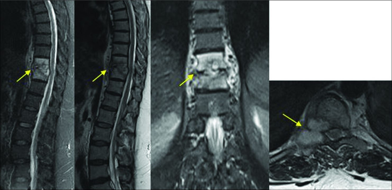 Multiplanar T2 and T2Fat sat MR images depict absence of contiguous involvement, collapse and subligamentous spread, presence of intraosseous and paravertebral collections with thick abscess wall. Features sugggesting Pyogenic etiology with score of 1.