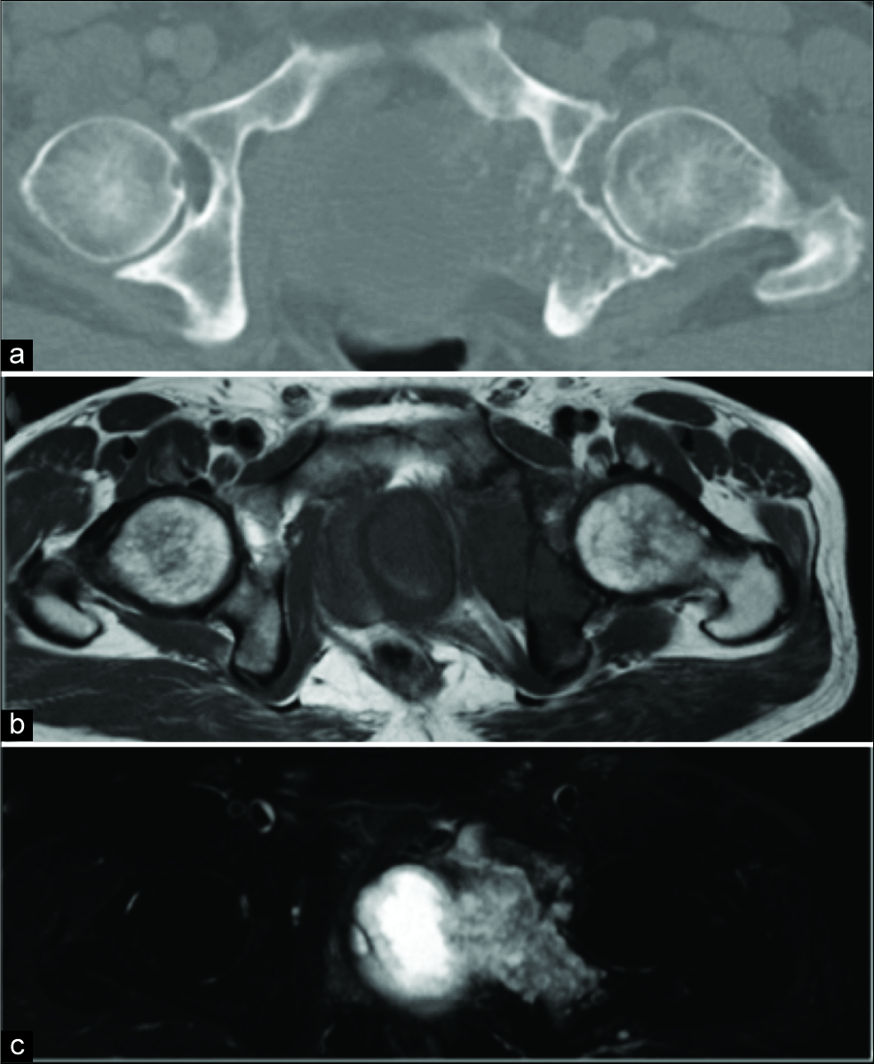 Chondrosarcoma. Axial computed tomography (a), T1 (b), and coronal short-tau inversion recovery (c) demonstrating the left ischial chondrosarcoma.
