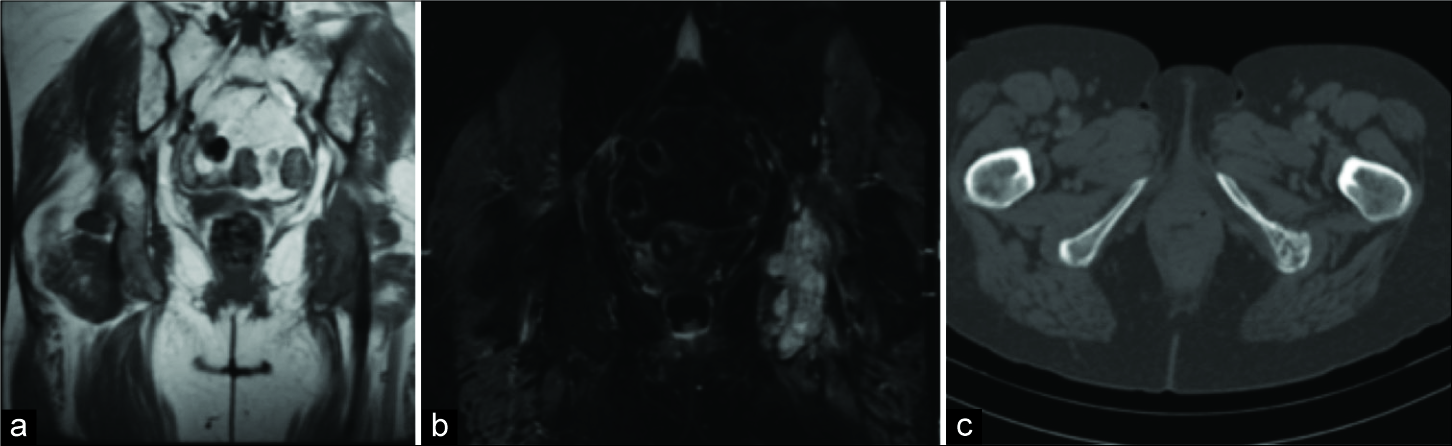 Ewing’s sarcoma. Coronal T1 (a), short-tau inversion recovery (b), and axial computed tomography (c) showing Ewing’s sarcoma of the left ischium.