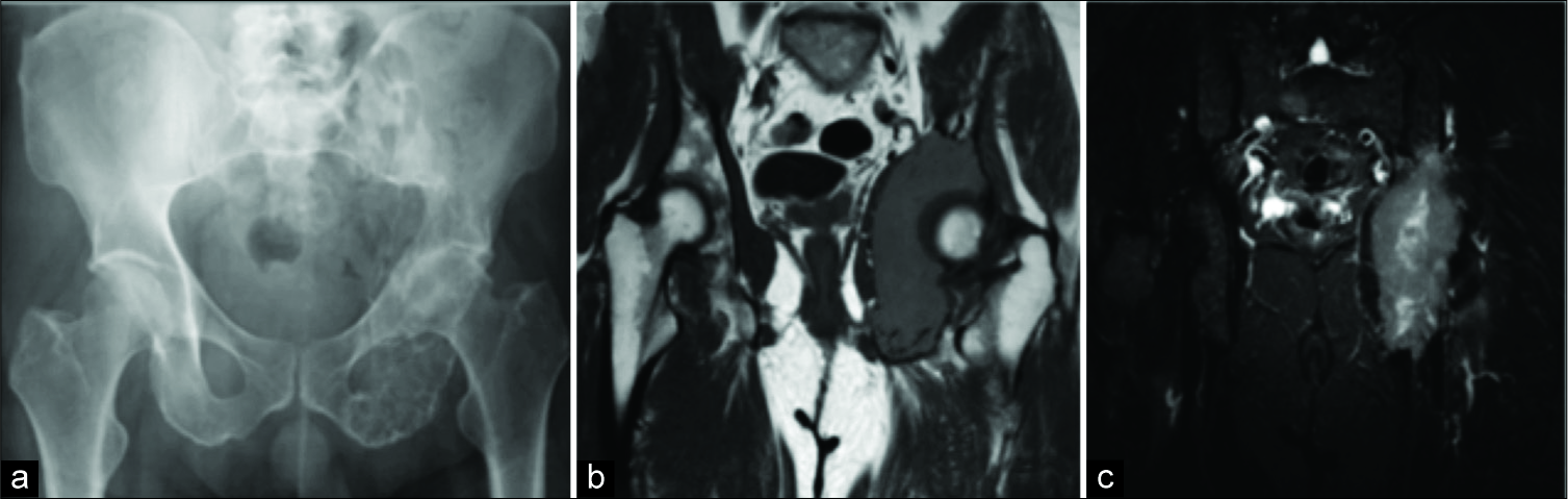 Plasmacytoma. Radiograph (a), coronal T1 (b), and short-tau inversion recovery (c) demonstrating large destructive lesion of the left ischium and acetabulum.