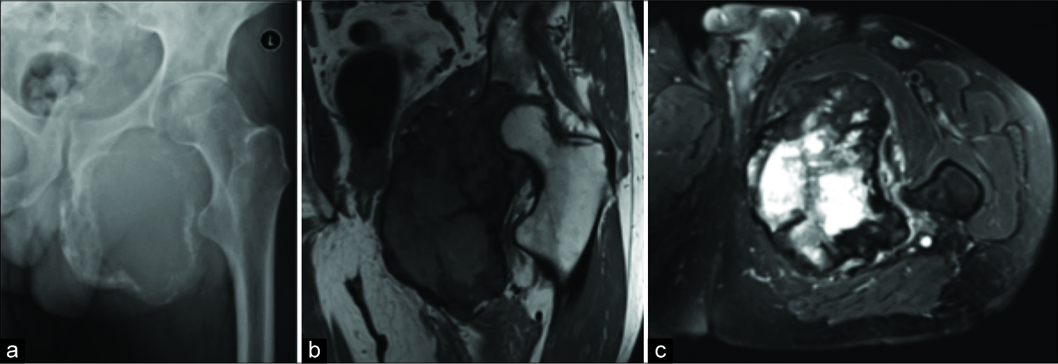 Giant cell tumor. Radiograph (a), coronal T1 (b), and axial short-tau inversion recovery (c) demonstrating large destructive lesion of the left ischium and acetabulum.