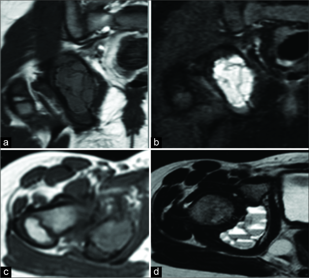 Aneurysmal bone cyst. Coronal T1 (a), short-tau inversion recovery, (b) axial, T1 (c), and T2 (d) demonstrating the right ischial lesion with fluid-fluid levels.