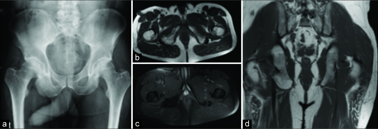 Chronic avulsion fracture of the ischium. Radiograph (a), axial T1 (b), short-tau inversion recovery (c), and coronal T1 (d) demonstrating chronic healed avulsion fracture of the right ischium.