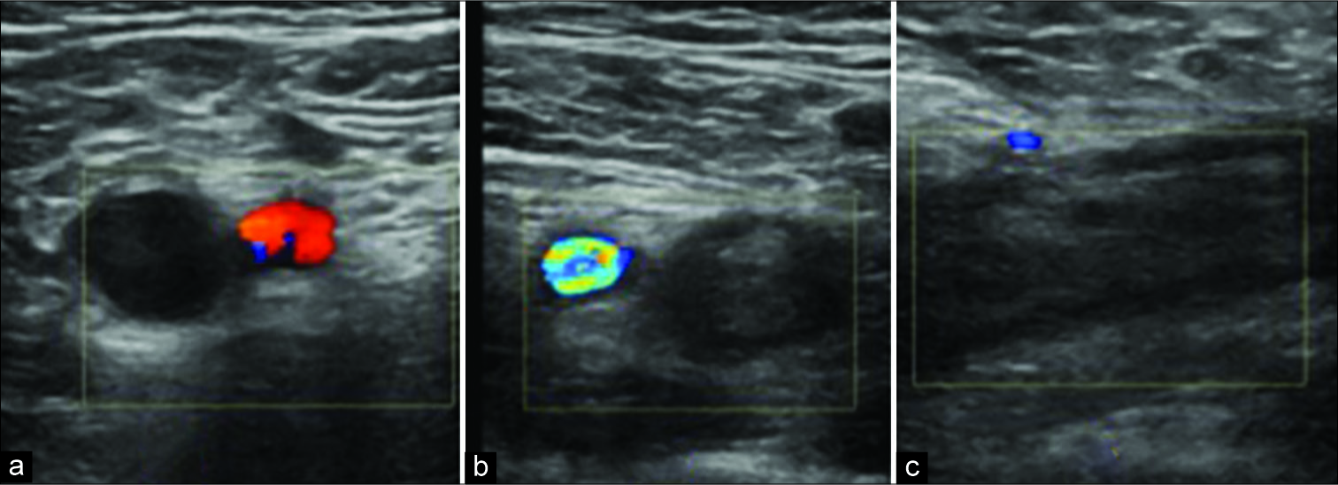 Color Doppler ultrasound of the right (a) and left (b and c) common femoral vein (CFV). A = Transverse view of the normal compressible right CFV with no filling defect. B = Abnormal left CFV with echogenic thrombus in the CFV which is non-compressible and no color flow. C = Longitudinal view of the echogenic thrombus occupying the CFV in keeping with a deep vein thrombosis.