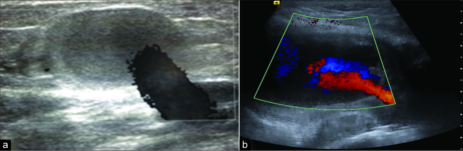 Transverse ultrasound image (a) of the popliteal artery demonstrating a jet of blood flowing into a thrombosed pseudoaneurysm secondary to trauma. (b) Ultrasound demonstrating the turbulent forward and backward flow where a characteristic Ying-Yang sign may be seen on color flow Doppler.