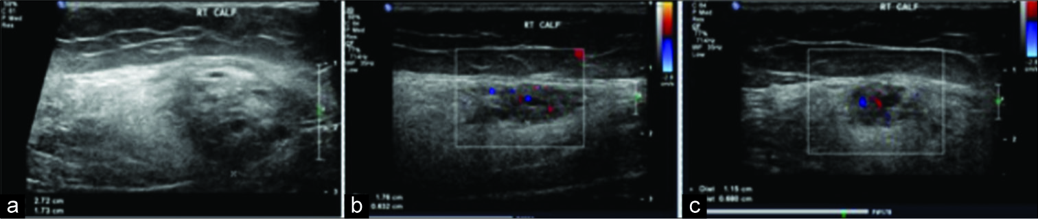Ultrasound images demonstrating a heterogeneous intramuscular mass with cystic areas (a). There is hypervascularity on color Doppler imaging (b). Appearances are in keeping with a vascular lesion (c).