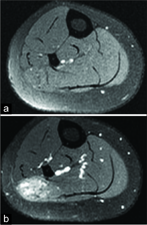 Pre (a) and post (b) contrast axial T1 fat-saturated axial Magnetic resonance images. This demonstrates the lateral soleus intramuscular arteriovenous malformations with intense enhancement after the administration of IV gadolinium.