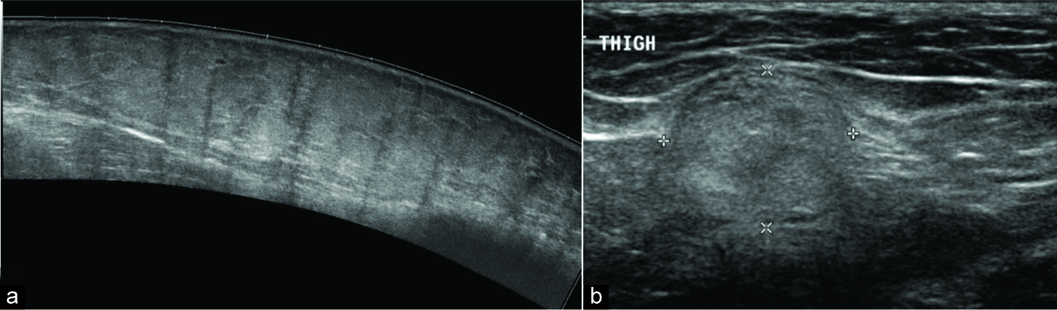 (a) Panaromic image of the lower leg demonstrating a superficial subcutaneous fatty lesion, which is isoechoic to the surrounding, fat and is compressible. No aggressive imaging features demonstrated in keeping with a superficial lipoma. (b) Transverse ultrasound image of an intramuscular lesion which is echogenic typical for an intramuscular lipoma. Due to its location, an magnetic resonance imaging should be performed to characterize it.