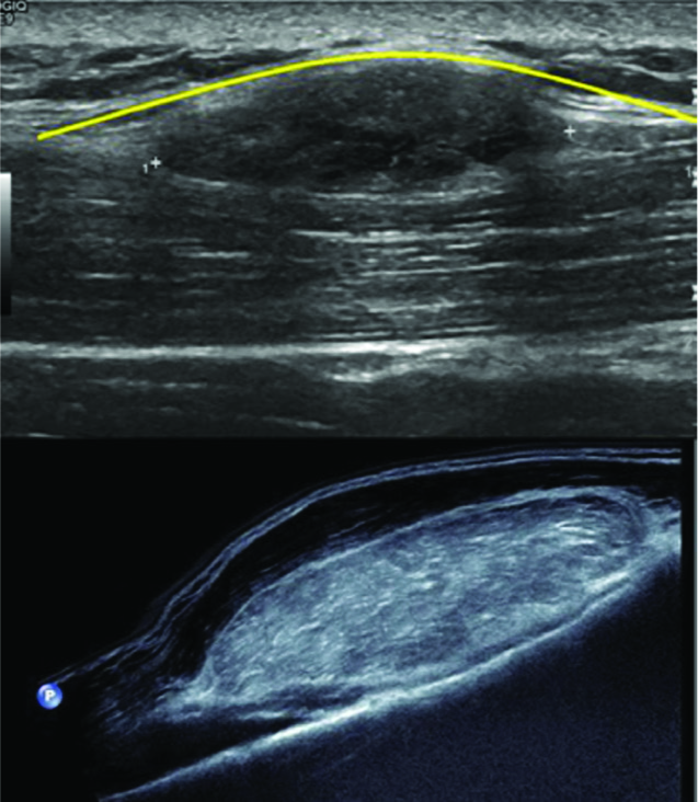 Top image: Sagittal ultrasound image of the lower leg demonstrating a hypoechoic lesion, which is deep to the deep fascia (yellow curvilinear line). The patient went on to have a subsequent magnetic resonance (MR), and the lesion followed fat signal on all sequence in keeping with a deep lipoma. Bottom image: A large hyperechoic lesion deep to the muscle abutting the underlying fibula in keeping with a deep lipoma (proven on MR – images not shown).