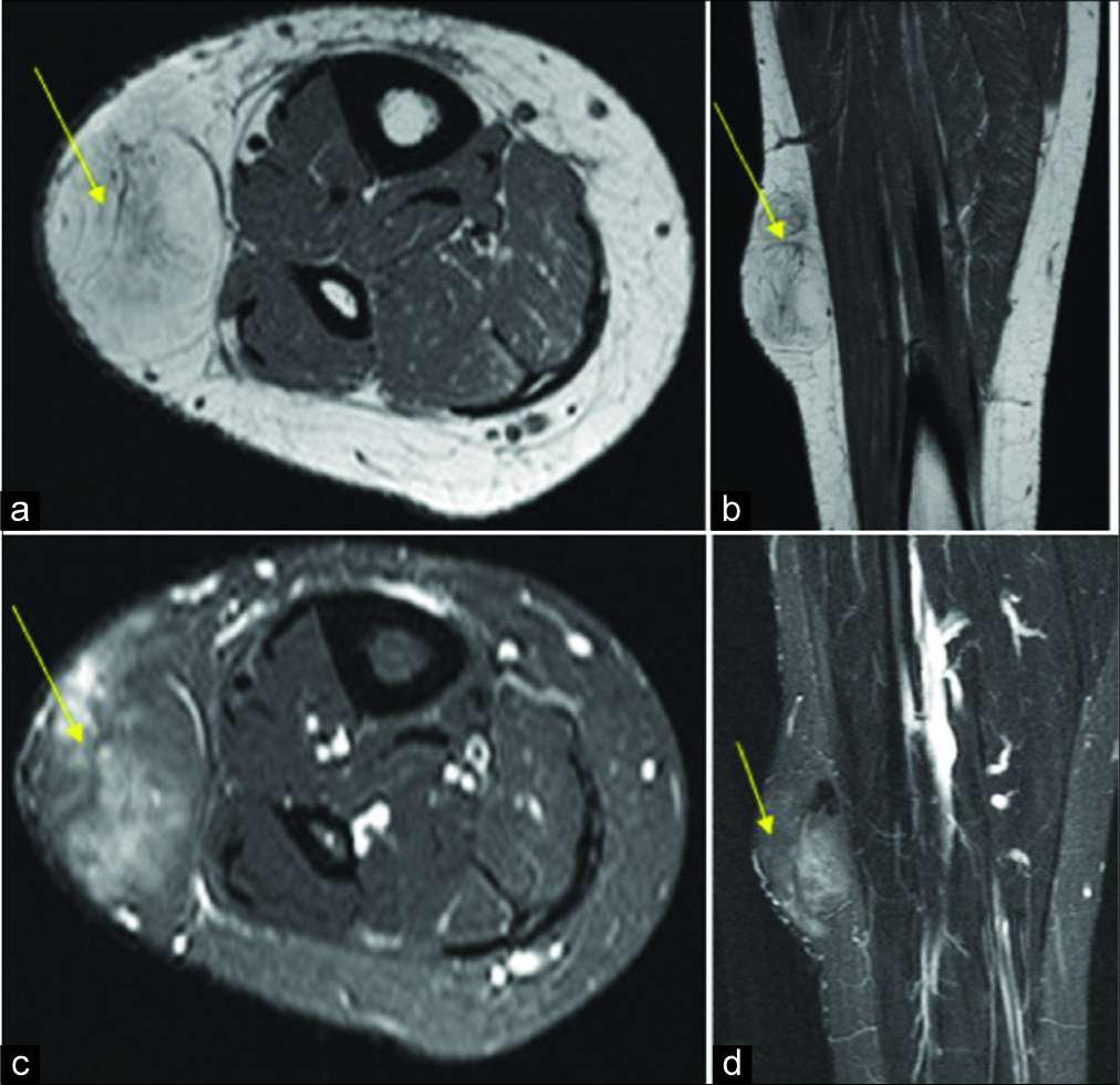 Axial T1 (a), coronal T1 (b), short tau inversion recovery (STIR) axial (c), and STIR coronal (d) magnetic resonance images of the lower leg demonstrating a subcutaneous fat signal lesion with incomplete suppression. Excision biopsy confirmed a liposarcoma.