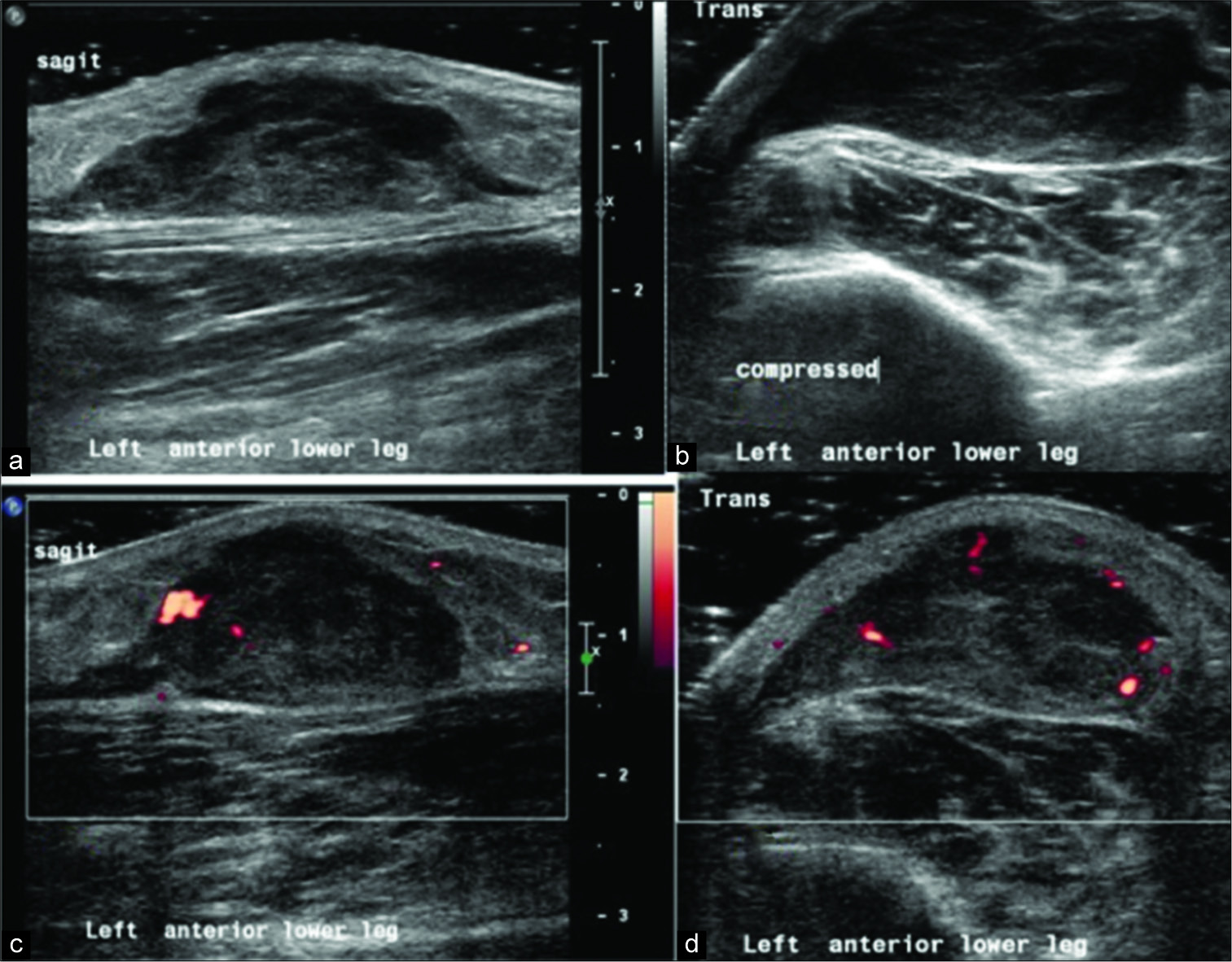 Longitudinal (a), axial (b) ultrasound image of a subcutaneous lesion that presented with a painful lower leg swelling. The heterogeneous lesion was non-compressible and with neovascularization (c and d). This aggressive-looking lesion was histologically confirmed to be a myxofibrosarcoma.