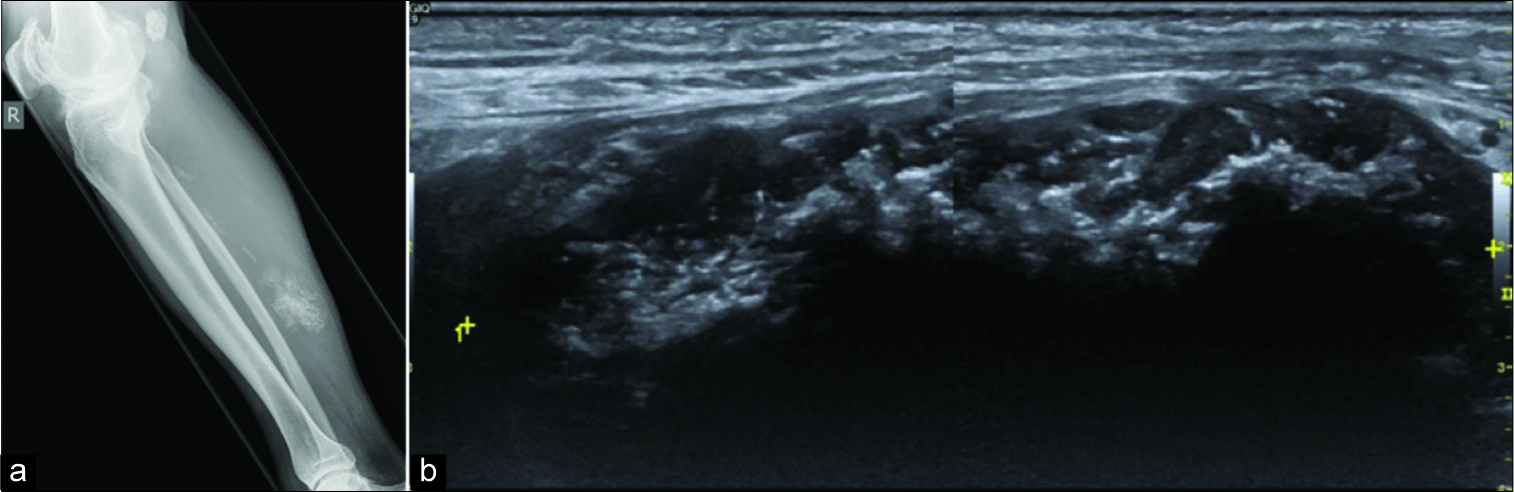 (a) Lateral radiograph of the patient in confirming calcification in the mass in the posterior aspect of the calf. (b) Extended field of view longitudinal ultrasound of the right calf demonstrates a hypoechoic mass with intralesional calcification, located within the soleus muscle.