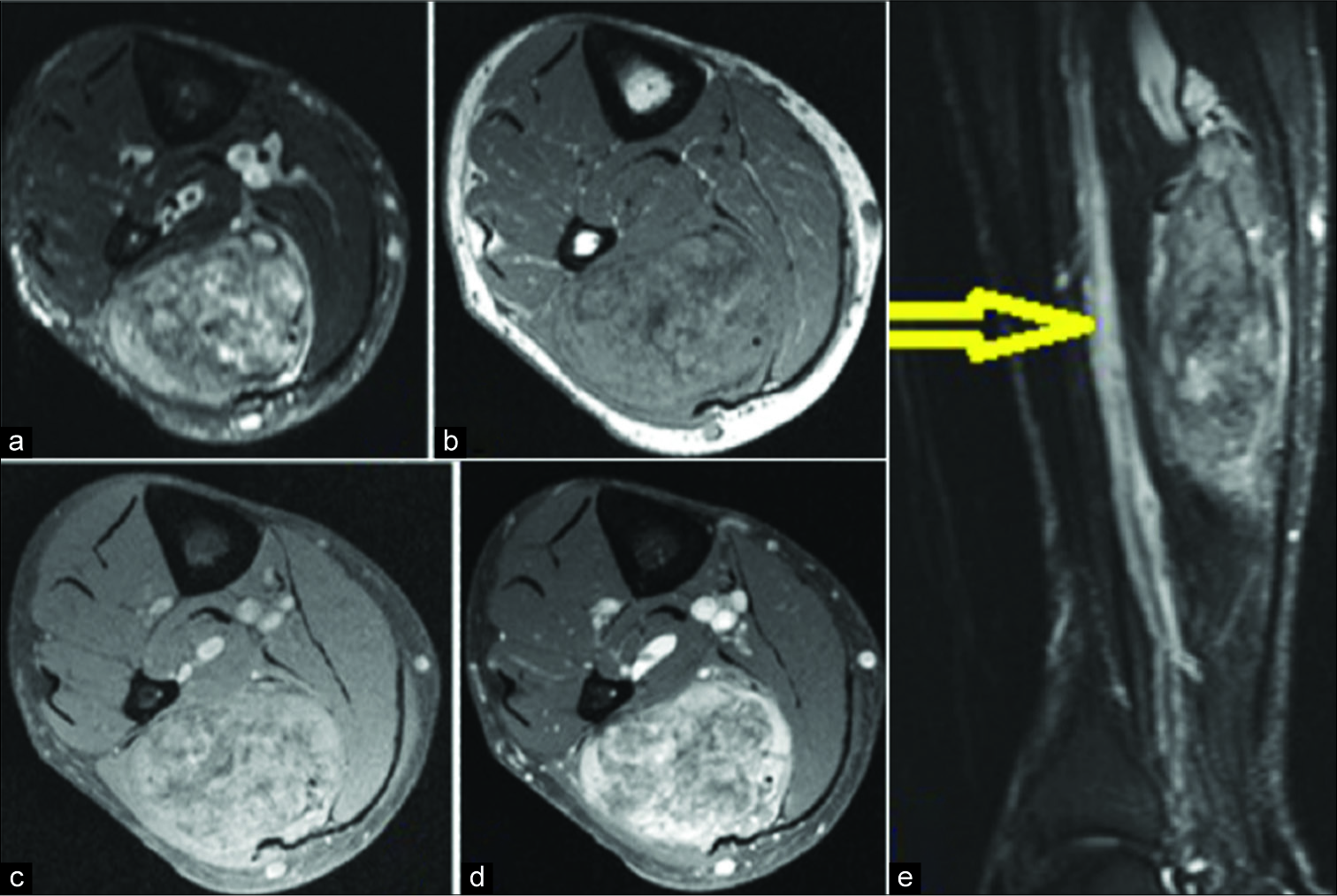 Axial short tau inversion recovery (STIR) (a), T1 (b), pre-contrast T1 FS (c) and post-contrast T1 FS (d) and STIR sagittal (e) of the patient in Figure 23 demonstrate a large enhancing solid soft tissue mass with central necrosis and diffuse calcification within the medial belly of the soleus muscle with an adjacent dilated deep vein (yellow arrow). A biopsy confirmed chondrosarcoma.
