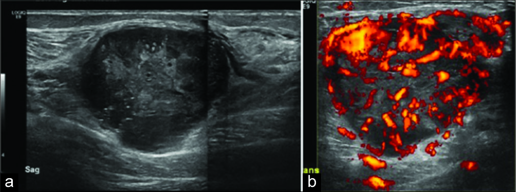 Extended view sagittal ultrasound image (a) of the lower leg demonstrating a large heterogeneous soft tissue lesion with marked hypervascularity on power Doppler imaging (b) subsequent biopsy confirmed a malignant fibrous tumor.