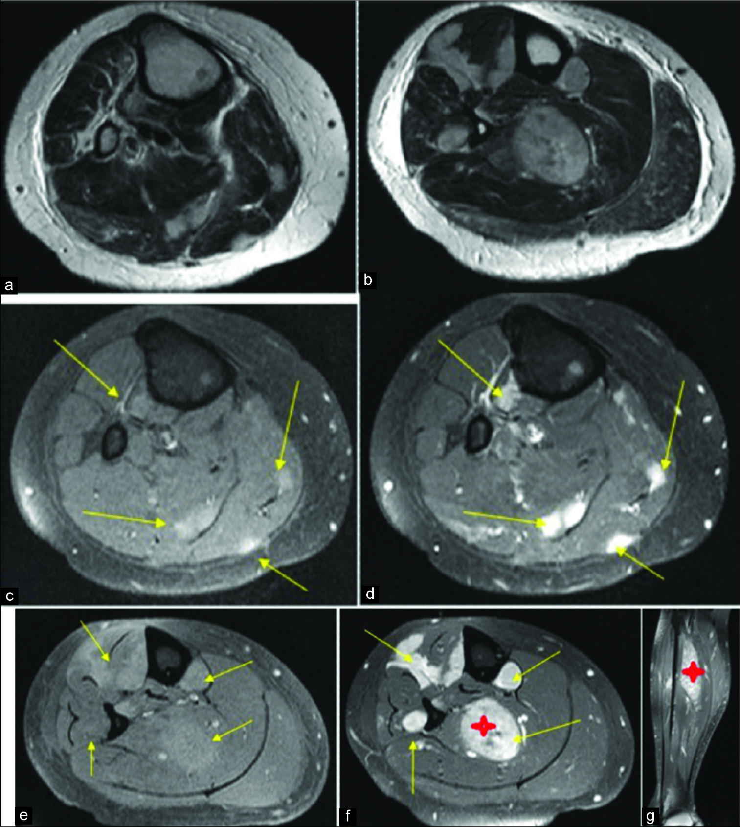 Axial T2 images (a and b) demonstrating multiple hyperintense well-defined intramuscular lesions. Pre-contrast T1 FS images (c and e) and corresponding post-contrast T1 FS images (d and f) demonstrate intensely enhancing masses throughout the lower leg (arrows) with a large lesion in the soleus muscle (red star)(f and g). The patient was known to have adenocarcinoma of the colon.