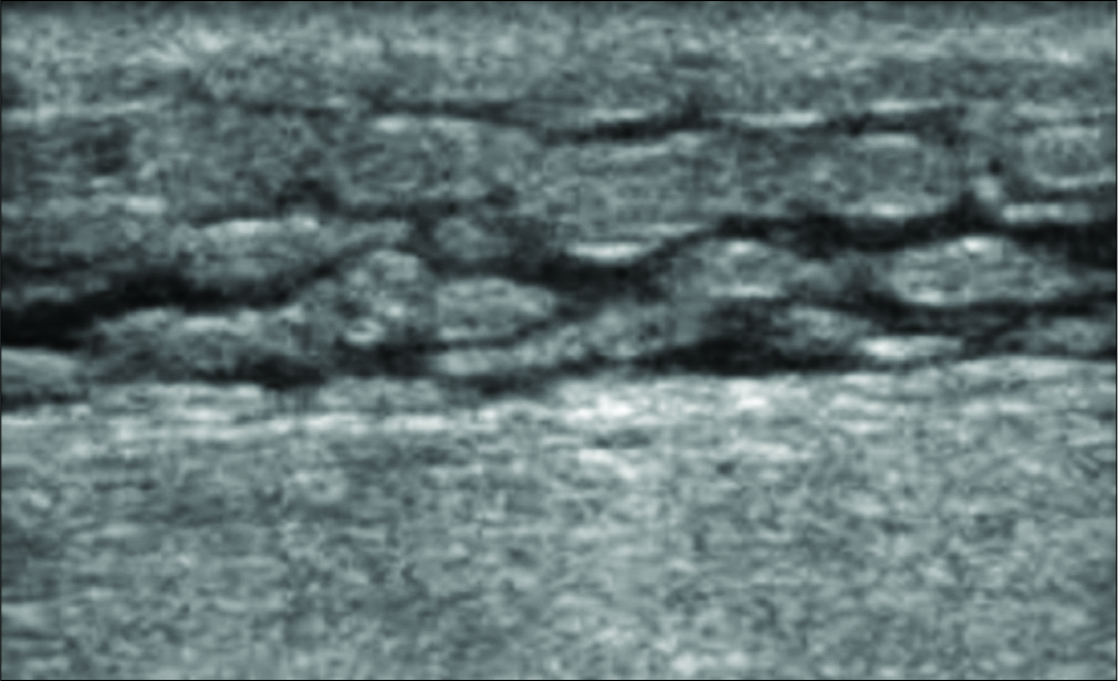 Ultrasound image of the subcutaneous fat demonstrating the “cobble appearance” of edematous fat. The fluid is interdigitating between the fat globules. Septic versus aseptic fluid cannot be distinguished on imaging.
