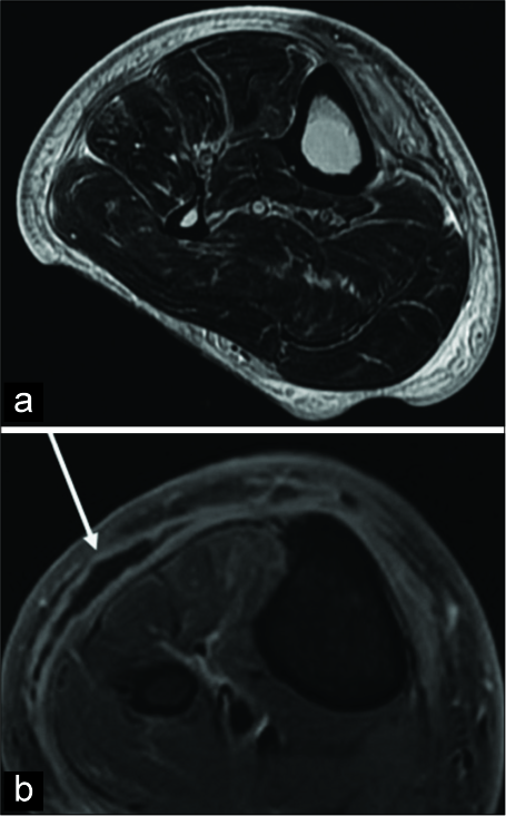 Axial T2-weighted magnetic resonance (a) demonstrating increased T2 signal throughout the subcutaneous fat and perifascial edema in keeping with cellulitis, a focal rim enhancing collection (white arrow) is seen in the post-contrast T1 FS axial image (b) represents a subcutaneous abscess. No air seen to suggest necrotizing fasciitis.