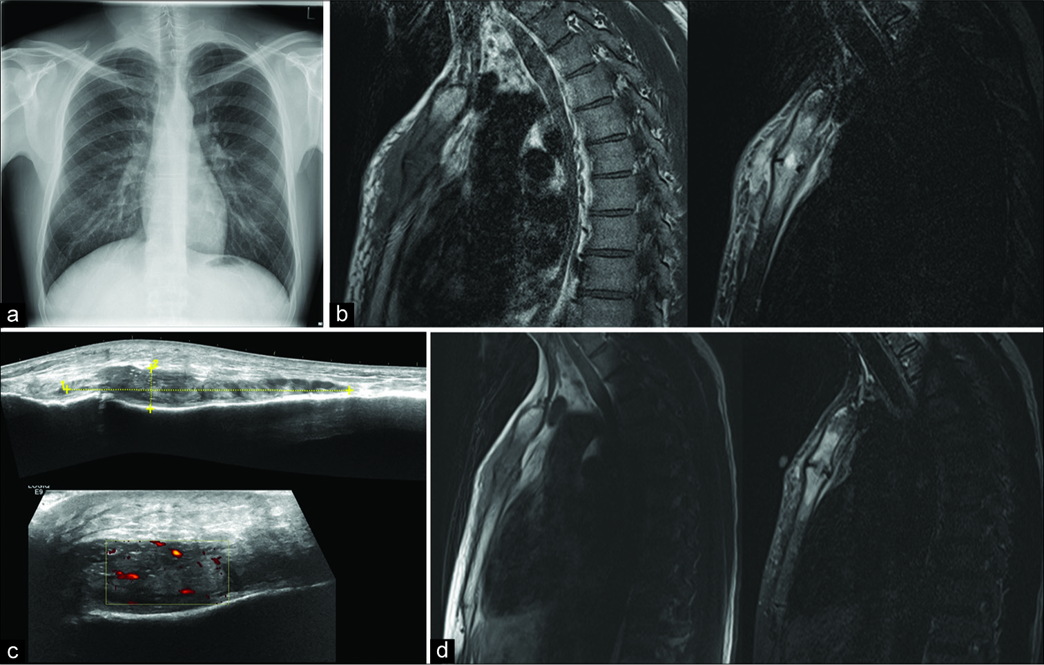 A 30-year-old male presented with a 4-week history of chest discomfort and pain. Blood tests including white cell count and inflammatory markers were normal and the patient suffered from no systemic symptoms. (a) Posteroanterior chest radiograph did not show any abnormality. The patient proceeded to magnetic resonance imaging for further evaluation. (b) Selected sagittal T1-weighted (left) and short-tau inversion recovery (STIR) (right) magnetic resonance imaging (MRI) through the manubriosternal joint. T1-weighted imaging demonstrates hypointense signal within both the manubrium and proximal sternal body with corresponding high signal on STIR imaging consistent with bone marrow edema. In addition, there is a low T1 weighted and intermediate to high STIR signal subcutaneous soft tissue changes seen at and anterior to the manubriosternal joint. (c) Ultrasound images at the level of the manubriosternal joint show a mixed echogenicity subcutaneous abnormality with increased Doppler flow corresponding to the MR findings. (d) Septic arthritis and SAPHO syndrome were raised as possible differentials. The case was discussed at a multidisciplinary meeting and decided a trial treatment with nonsteroidal anti-inflammatory drugs and follow-up imaging in 1 month. No antibiotics were used in patient management. Follow-up sagittal T1-weighted (left) and STIR (right) MRI show improved appearances and the diagnosis of synovitis, acne, pustulosis, hyperostosis, and osteitis was confirmed at this point.