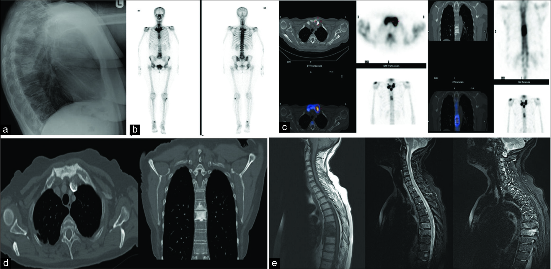 A 53-year-old female who was a known smoker presented with non-specific chest and thoracic back pain. (a) Sclerotic foci were seen on the lateral chest radiograph which raised the concern for potential metastatic disease. (b) Abnormal tracer uptake was noted around both sternoclavicular and sternocostal joints (bull’s head sign) and in the thoracic spine. (c) Additional single-photon emission computed tomography (CT)-CT images were acquired of the same patient which demonstrated areas of hyperostosis. The reporting radiologist felt unable to exclude osseous metastatic disease. (d) Selected axial and coronal bony reformats from the whole body CT demonstrates focal areas of sclerosis and hyperostosis centered on the sternocostal joints and the mid-thoracic vertebrae. No primary malignancy or evidence of disseminated metastatic disease. A musculoskeletal radiologists opinion was sought who recommended a magnetic resonance imaging (MRI) for further evaluation with high suspicion of synovitis, acne, pustulosis, hyperostosis, and osteitis (SAPHO) as the diagnosis. (e) Selected sagittal T1-weighted (left) and short-tau inversion recovery (STIR) (middle and right) MRI of the cervicothoracic spine shows T1 hypointense signal in the T7 and T8 vertebral bodies with corresponding high STIR signal here and in the costotransverse junction in keeping with edematous change (osteitis). No further abnormality demonstrated. The patient was referred to rheumatology who confirmed the diagnosis of SAPHO syndrome.