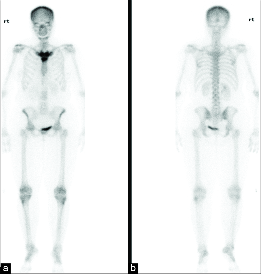 A 52-year-old female with anterior chest pain and prior history of treated breast cancer. (a) A bone scintigram was performed which demonstrated focally increased tracer uptake centered around the proximal sternum and its clavicular and costal articulations bilaterally. “Bulls head” sign.