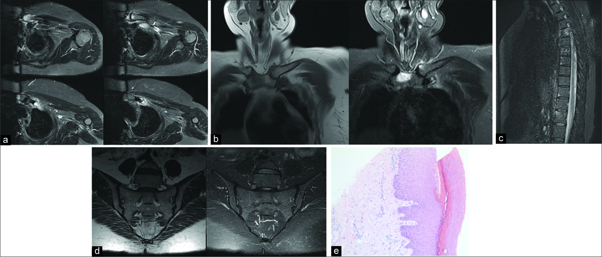 A 52-year-old female presented with non-specific neck and interscapular pain and was referred for a cervical spine magnetic resonance imaging for possible nerve root irritation. (a) No significant central or neural foraminal narrowing within the cervical spine. No abnormality seen relating to scapula on dedicated imaging. Axial short-tau inversion recovery (STIR) imaging demonstrated unexpected findings of edema adjoining the left sternoclavicular joint and also the left first and second costal cartilages. These unexpected findings led to patient recall for dedicated imaging of the anterior chest and SIJ protocol imaging. (b) Coronal T1-weighted (left) and STIR (right) magnetic resonance imaging (MRI) through the sternum demonstrated a couple of foci of low T1 and high STIR signal intensity within the right aspect of the manubrium and left medial clavicle which raised the suspicion for synovitis, acne, pustulosis, hyperostosis, and osteitis (SAPHO) syndrome. (c) Sagittal STIR MRI of the lower cervical and upper thoracic spine showed focal areas of bone marrow edema at the anterior aspects of a few vertebral bodies and at the costotransverse junction. This raised the concern for seronegative arthropathy such as ankylosing spondylitis. (d) Normal appearances of the sacroiliac joints. By this time, the patient had given history of palmar rash on direct questioning. The diagnosis of SAPHO syndrome was made. (e) Punch biopsy skin lesion showing a subcorneal pustule. The epidermis and dermis are otherwise within normal limits. *Image courtesy of Dr. Sara Edward, Consultant in Soft tissue and Dermatopathology. Leeds Teaching Hospital Trust.