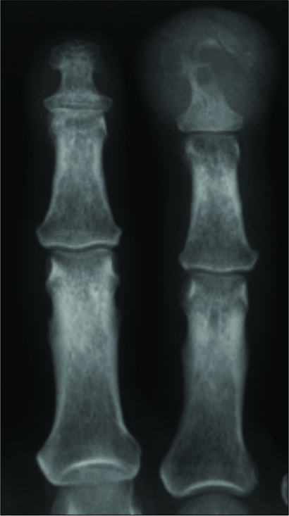 Osteomyelitis. AP radiograph demonstrates osteomyelitis of the distal phalanx secondary to a soft tissue infection with significant soft tissue swelling.