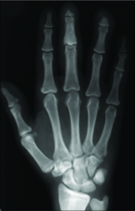 Leprosy. AP radiograph demonstrates bony sclerosis with resorption of the terminal tufts of the middle and ring fingers.