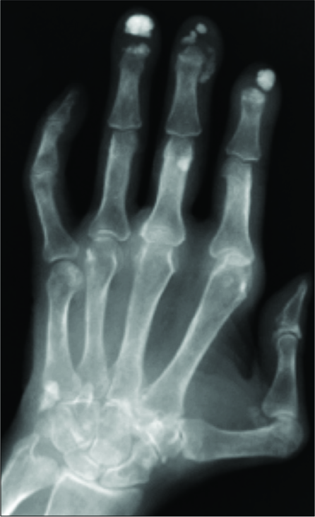 Scleroderma. AP radiograph of the hand shows acro- osteolysis and calcinosis in the distal phalanges.
