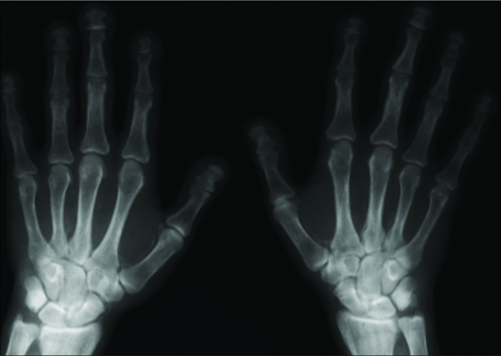 Acro-osteolysis. AP radiograph of both hands demonstrates acro-osteolysis of the terminal tufts in a patient with chronic kidney disease.