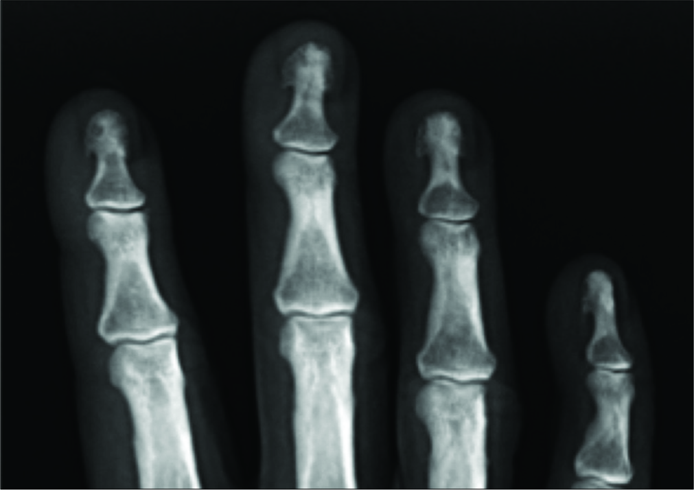 Acro-osteosclerosis. AP radiograph showing focal sclerosis across all four terminal tufts of the distal phalanx. Note how the terminal tuft itself has a well-defined margin despite the spade-shaped lobulations/irregularities associated with aging.