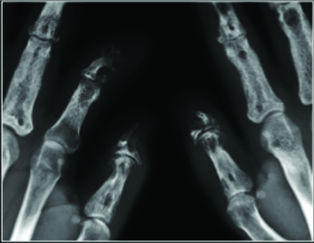 Sarcoidosis. AP radiograph demonstrates multiple punched-out lytic lesions throughout the phalanges sparing the articular surfaces. Note that some of the lesions have the typical honeycomb trabeculation pattern. There is also marked osteolysis affecting the terminal tufts with secondary remodeling.