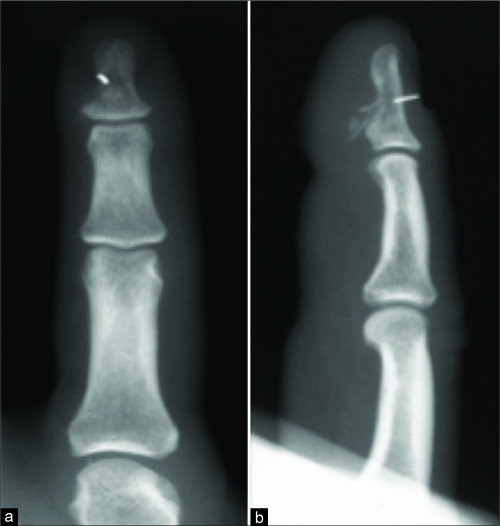 Foreign body. Radiographs AP (a) and lateral (b) demonstrates a radio-opaque foreign body in the projection of the soft tissue and distal phalanx.