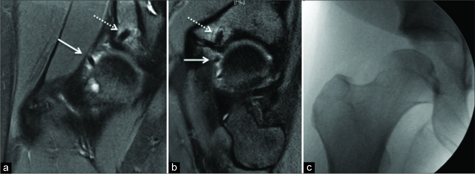 PDFS coronal oblique (a) and sag oblique (b) showing intact anchor (dotted arrow) and detached anchor (arrow). Note that AP fluoroscopy of the right hip (c) does not show the anchor (radiolucent).