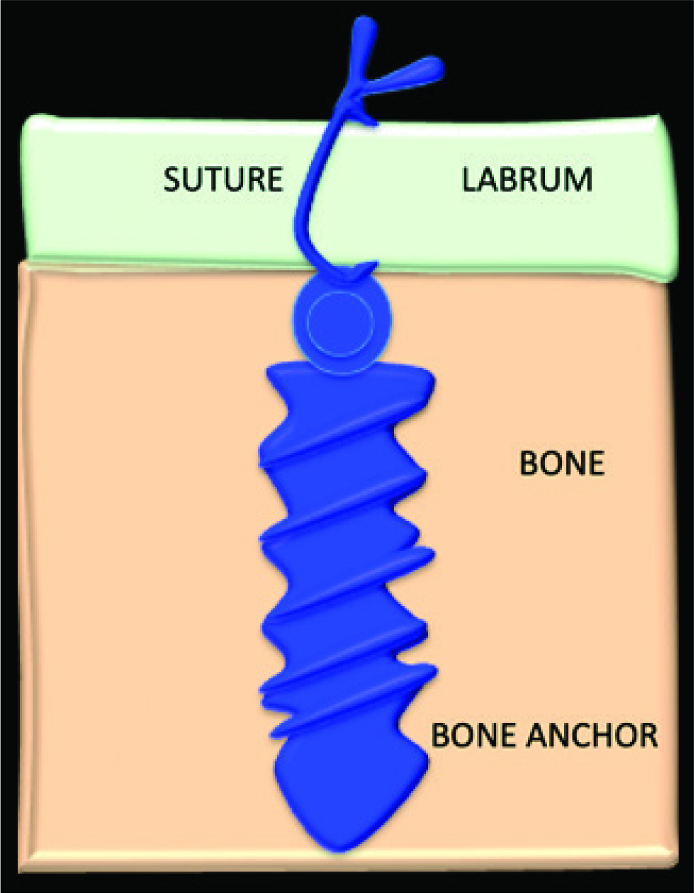 Diagrammatic representation of bone anchor and suture.