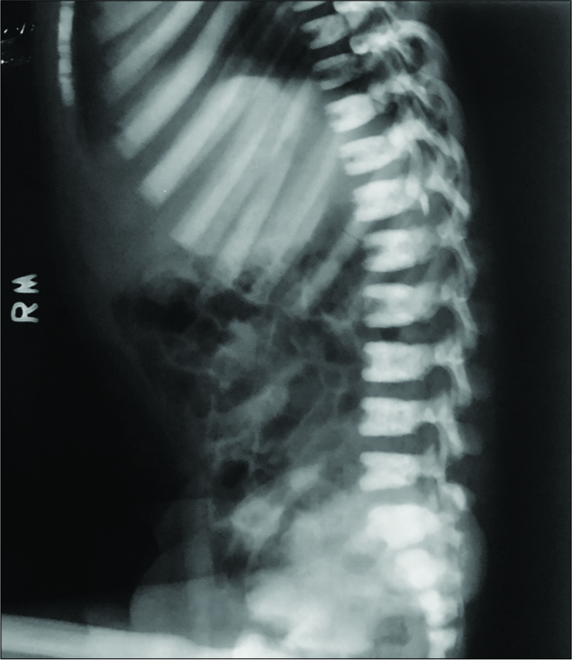 X-ray of dorsolumbar spine in lateral view shows dense bands along the superior and inferior endplates (sandwich vertebrae).