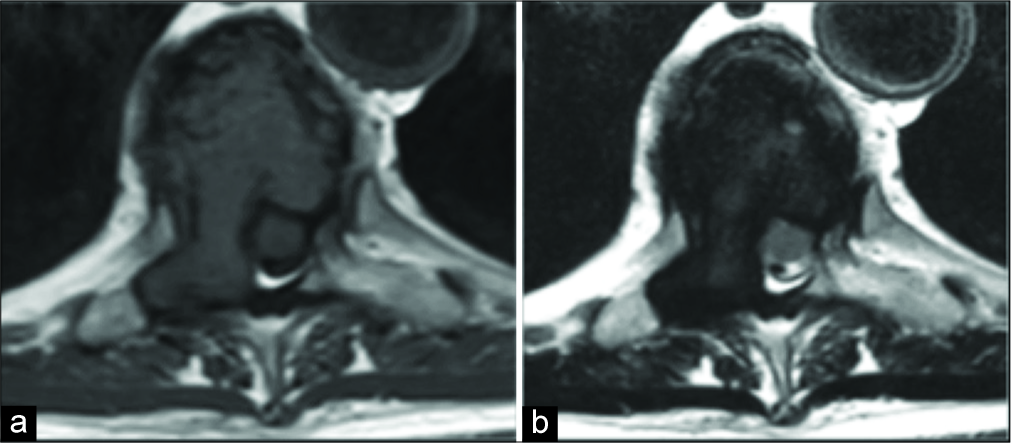 Axial T1 (a) and T2 (b) show T1 and T2 low-signal lesion in the vertebral body of T7 with extension into the right pedicle and right transverse process.