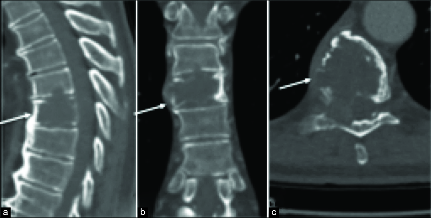Sagittal (a), coronal (b), and axial (c) show large lucent lesion (arrow) in the vertebral body of T7 with extension into the right pedicle.