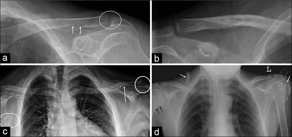 (a) A 37-year-old female and (c) a 33-year-old male with primary hyperparathyroidism: Subchondral resorption of the distal clavicle (circles), subtle findings of minimal irregularity, and indistinct margin of lateral clavicle (a) are better appreciated when compared to a normal radiograph (b); subligamentous resorption along the inferior clavicle at the site of attachment of coracoclavicular ligament (arrows) as compared to normal (b) and subtle Looser’s zone or pseudo-fracture along the axillary border of right scapula (circle in c). (d) A 35-year-old male with secondary hyperparathyroidism (renal osteodystrophy): Minimal cortical irregularity along the medial cortex of the right upper humerus (black arrows) suggests subperiosteal resorption, soft tissue, and periarticular calcifications (white arrows).