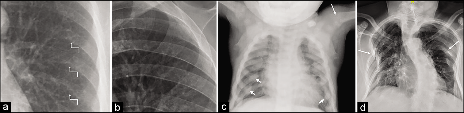 (a) A 37-year-old female with primary hyperparathyroidism: Subperiosteal resorption along the inferior margin of posterior ribs (arrows in a) in the form of loss of cortical definition well appreciated when compared with a normal radiograph (b) of the same age and sex. (c) A 4-year-old male child with renal rickets: The diffuse increase in bone density with enlarged costochondral junction due to expansion of anterior rib ends (“rachitic rosary”) (short arrows); flared and frayed proximal humeral metaphysis (long arrow). (d) A 42-year-old female with osteomalacia: Multiple insufficiency fractures of ribs, leading to chest wall deformity (arrows). Note the significant scoliotic deformity of the spine due to bone softening.