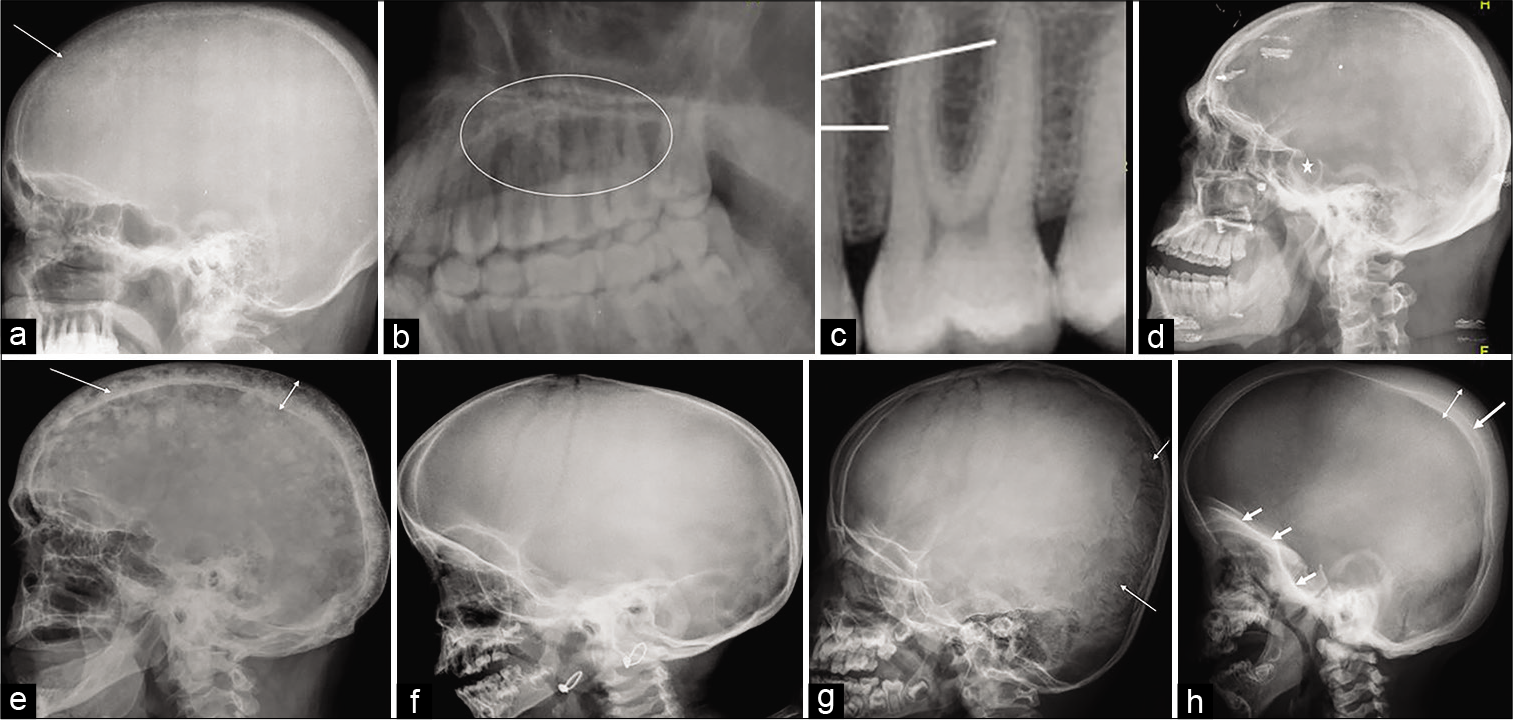 (a-b) A 40-year-old male with primary hyperparathyroidism: Lateral skull radiograph shows loss of definition of the inner table of the skull (arrow) with multiple punctate lucent and radiodense foci seen throughout the skull due to trabecular resorption, giving a “salt- and-pepper” appearance. Magnified image of upper jaw shows loss of lamina dura (circle) which is normally seen as radiopaque line (lines) surrounding the root of the tooth, as shown in image (c). (d) A 41-year-old male with acromegaly: Lateral skull radiograph reveals enlarged sella (star) with double flooring, thickened skull vault, enlarged paranasal sinuses, and prognathism. (e) A 63-year-old male with Paget’s disease: Lateral radiograph of the skull shows widening of the diploic space (double headed arrow) with thickened outer and more extensively inner (long arrow) tables; innumerable mixed lytic and sclerotic foci within the skull giving a typical “cotton wool” appearance. (f) A 26-month- old female with rickets: Lateral skull radiograph shows thinning of the calvarium; abnormal widening of skull sutures and fontanelles. (g) A 6-month-old male with osteogenesis imperfecta: Lateral skull radiograph demonstrates thinning of the skull with multiple wormian bones are noted predominantly in the occipital region within the lambdoid suture (arrows). (h) A 4-year-old male with osteopetrosis: Lateral skull radiograph reveals calvarial (double headed arrow) and basilar skull thickening (short arrows) and sclerosis, the inner table is more thickened and radiodense (long arrow) as compared to the outer table; poorly developed sinuses and mastoid process with defective dentition.