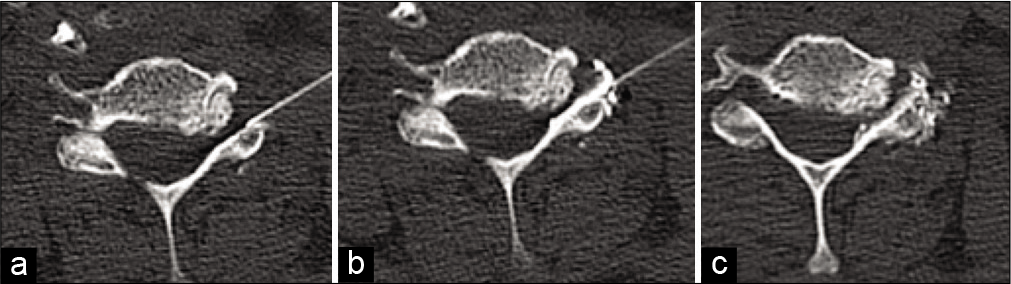 Axial CT images (a) showing needle over the left facet, (b) after injection of omnipaque contrast and (c) after injection of dexamethasone and 1% lidocaine.