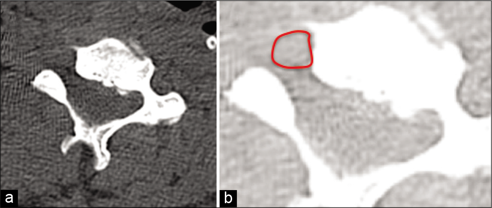 Axial CT (a) and (b) with 400% magnification(soft tissue window) showing area of the vertebral artery (red circle).