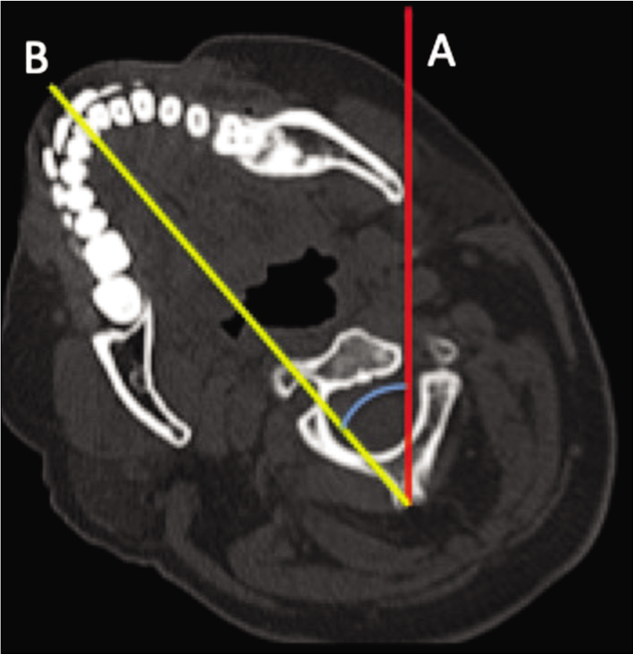 Axial CT showing angle of rotation calculated by drawing the line A (line perpendicular to the CT table centered over the posterior arch of the vertebra) and B (connecting the midpoint of the posterior arch of vertebra and midpoint of the mandible).