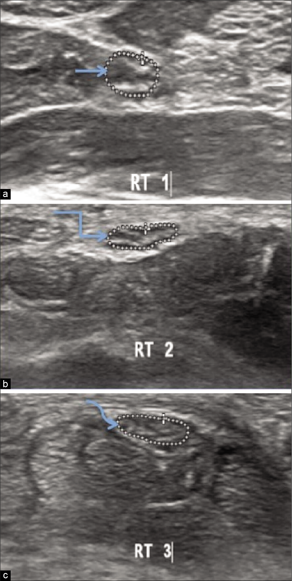 Ultrasonography image of the right median nerve of hypothyroidism patient at three levels in distal forearm showing (a) cross sectional area 0.060 cm2 at the level of pronator quadratus (straight arrow). (b) cross sectional area 0.057 cm2 proximal to the carpal tunnel inlet.(bent arrow) (c) cross sectional area 0.053 cm2 distal to the carpal tunnel outlet (curved arrow).