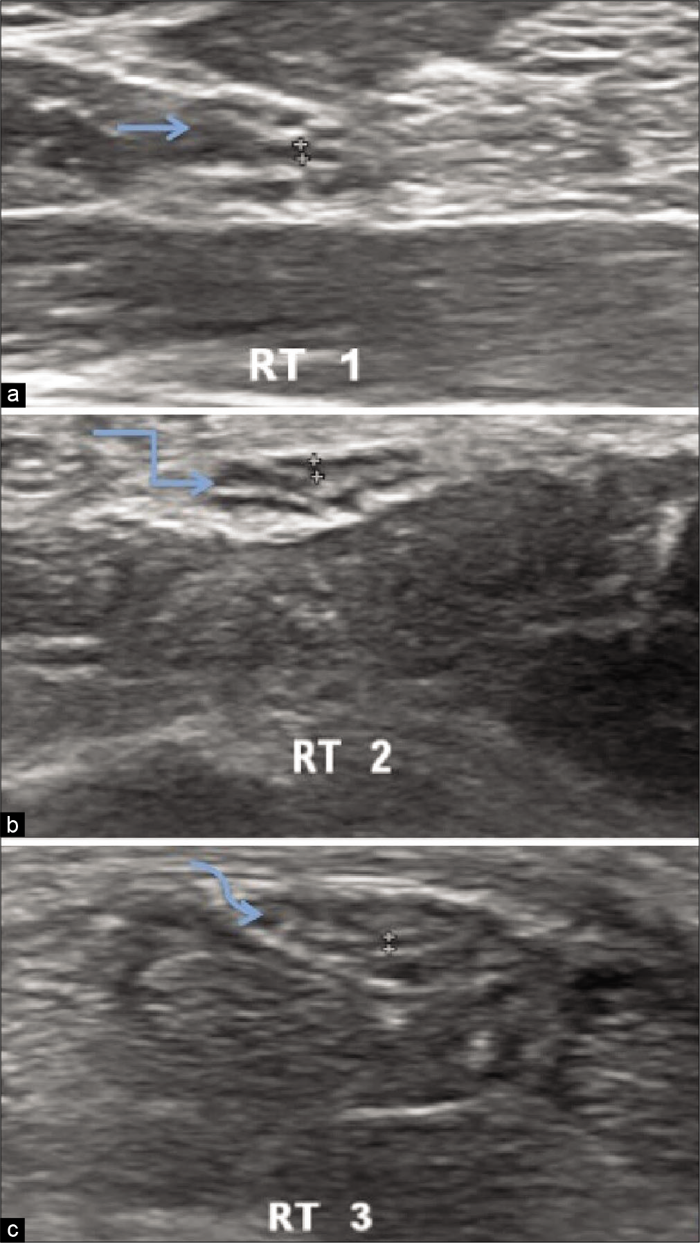 Ultrasonography of the Right median nerve of hypothyroidism patient showing hypoechoic median nerve fascicle thickness at three levels in distal forearm (a) Maximum thickness of nerve fascicle 0.035 cm at the level of pronator quadratus(straight arrow), (b) maximum thickness of nerve fascicle 0.043 cm proximal to carpal tunnel inlet(bent arrow), (c) maximum nerve fascicle thickness 0.033 cm distal to carpal tunnel outlet(curved arrow).