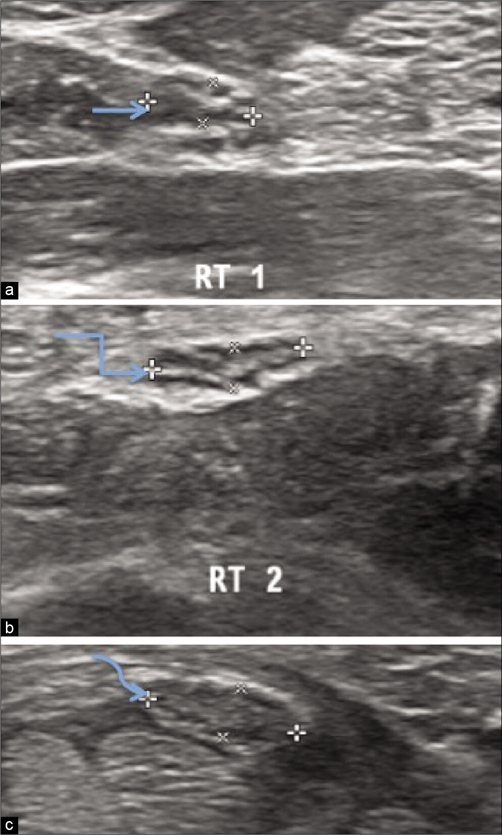Ultrasonography of the Right median nerve of hypothyroidism patient showing thickness /width ratio at three levels in distal forearm (a) thickness/width ratio 2.59 at the level of pronator quadratus,(straight arrow) (b) thickness/width ratio 3.23 proximal to carpal tunnel inlet, (bent arrow) (c) thickness/width ratio 2.75 distal to carpal tunnel outlet.(curved arrow).