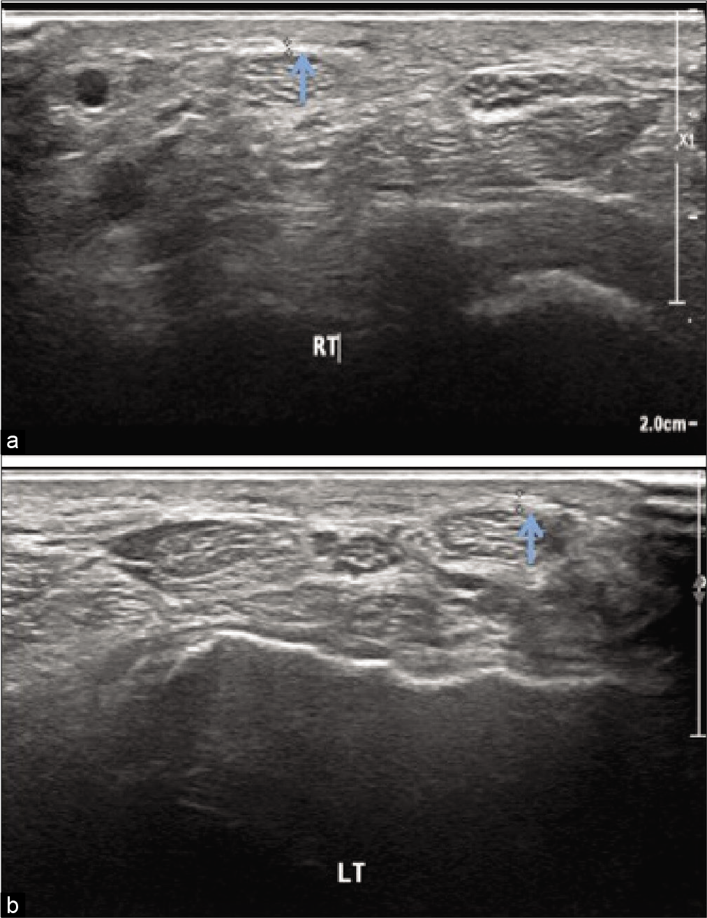 Ultrasonography image of the flexor retinaculum of hypothyroidism patient showing (a) thickness 0.07 cm on right side(arrow) and (b) 0.052 cm on left side(arrow).
