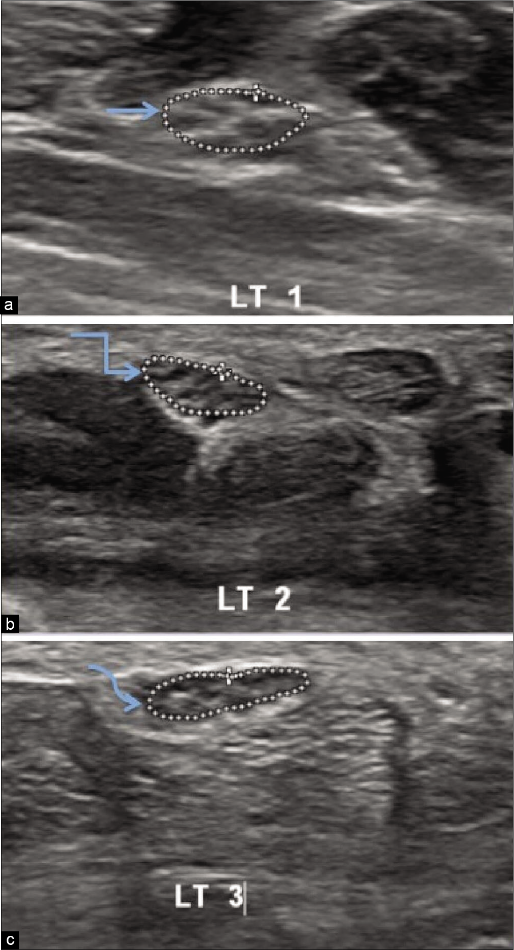 Ultrasonography image of the left median nerve of a healthy volunteer at three levels in distal forearm showing (a) cross sectional area 0.064 cm2 at the level of pronator quadratus.(straight arrow) (b) cross sectional area 0.067 cm2 proximal to the carpal tunnel inlet.(bent arrow) (c) cross sectional area 0.069 cm2 distal to the carpal tunnel outlet.(curved arrow).