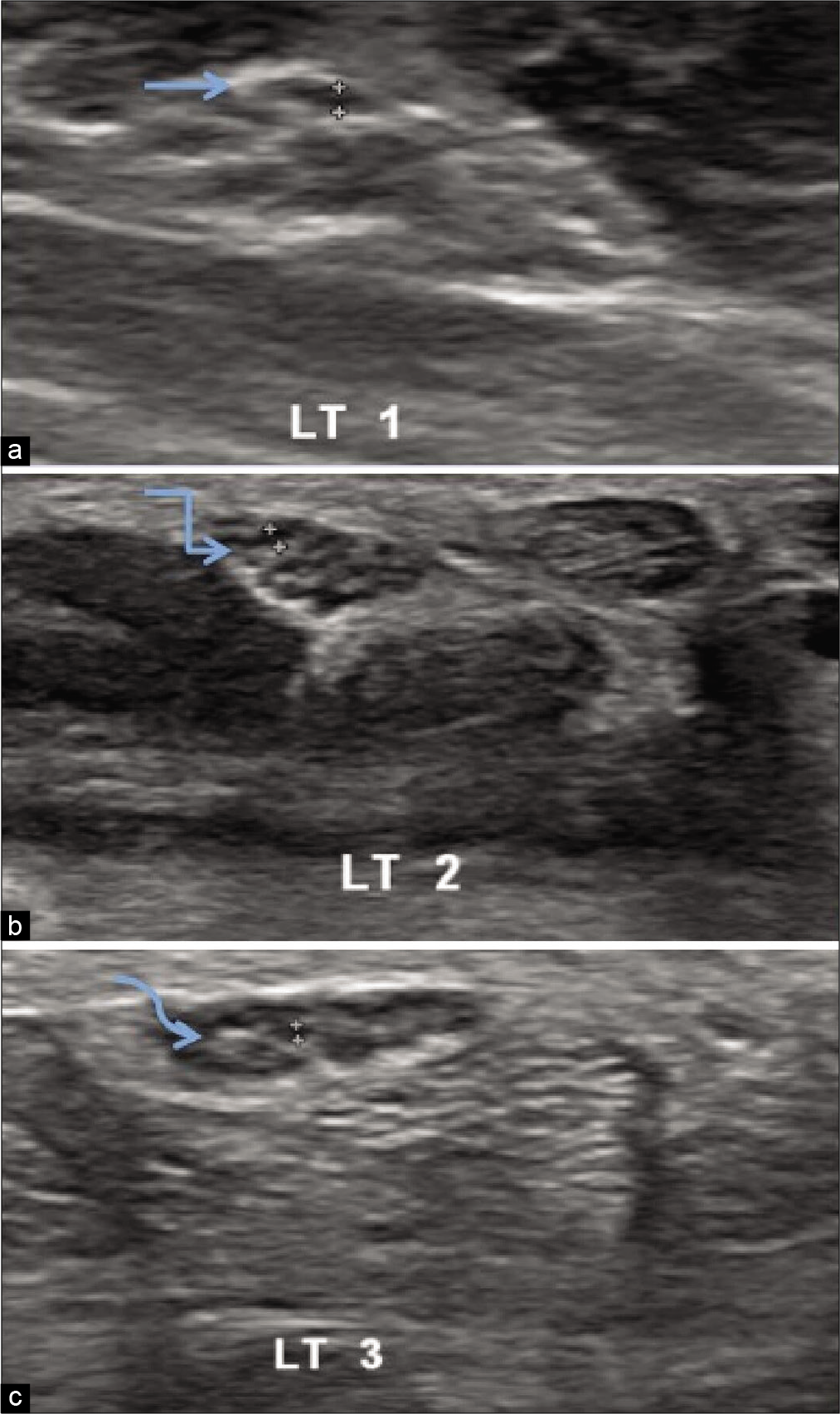 Ultrasonography of the left median nerve of healthy volunteer showing hypoechoic median nerve fascicle thickness at three levels in distal forearm (a) Maximum thickness 0.041 cm at the level of pronator quadratus(straight arrow), (b) maximum thickness 0.050 cm proximal to carpal tunnel inlet(bent arrow), (c) maximum thickness 0.033 cm distal to carpal tunnel outlet (curved arrow).