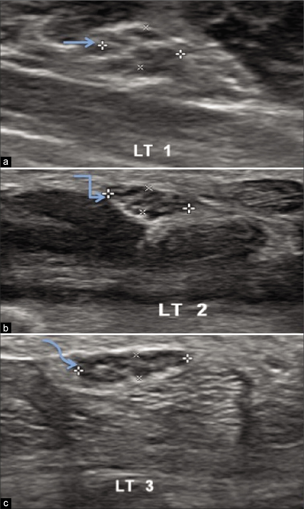 Ultrasonography of the left median nerve of healthy volunteer showing thickness /width ratio at three levels in distal forearm (a) thickness/width ratio 2.59 at the level of pronator quadratus,(straight arrow) (b) thickness/width ratio 3.03 proximal to carpal tunnel inlet, (bent arrow) (c) thickness/width ratio 2.89 distal to carpal tunnel outlet. (curved arrow).